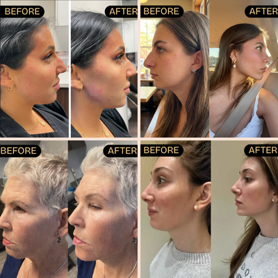 The V Sculpt™ Jaw Contouring Mask