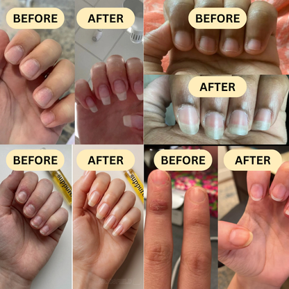 Suppuro NailLuxe™ Serum